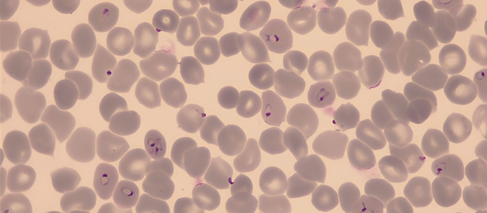 Red blood cells infected with Plasmodium falciparum
